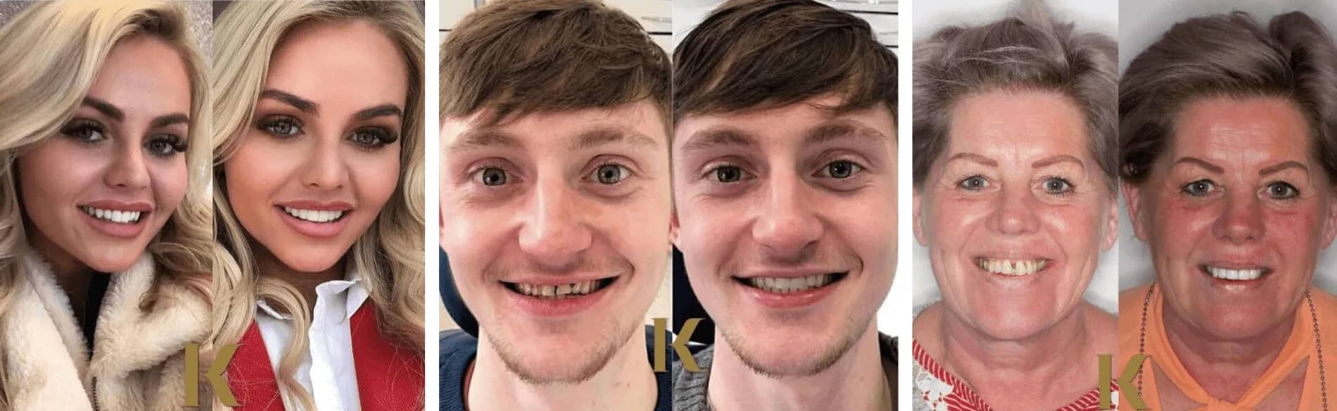 Smile makeover examples at Kiln Lane Dental