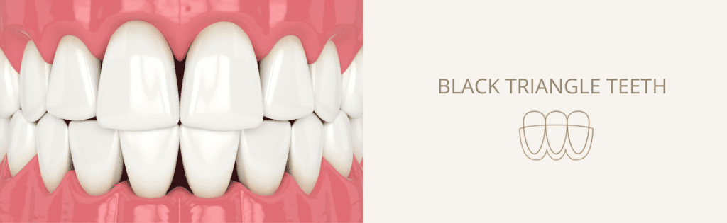 Black Triangle Teeth - St. Helens Dentist - Kiln Lane Dental